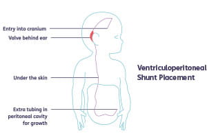 Shunt placement diagram